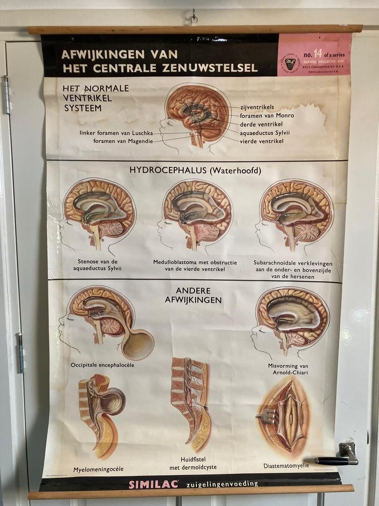 Oude schoolplaat "Afwijkingen Centraal Zenuwstelsel"., Ophalen of Verzenden, Natuur en Biologie